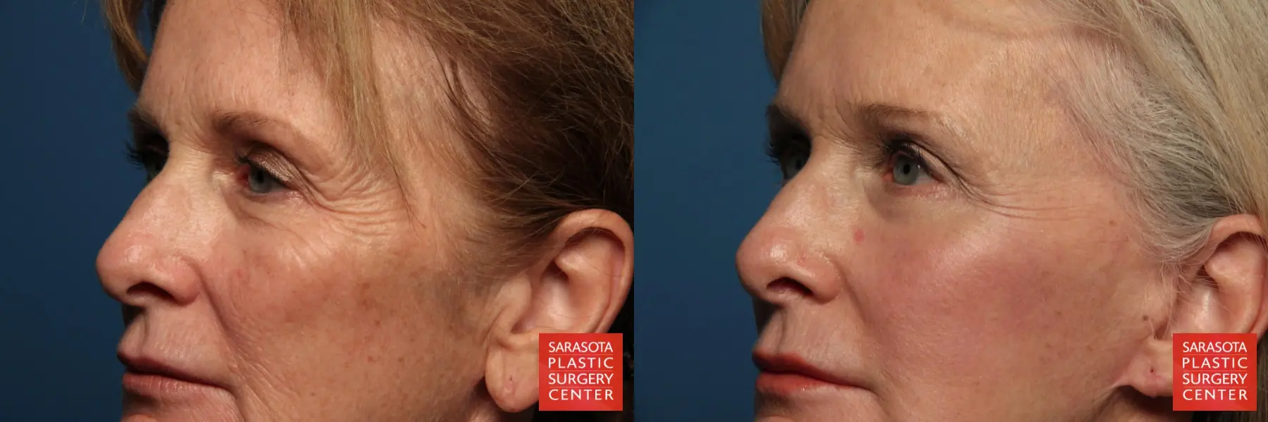 Eyelid Lift: Patient 3 - Before and After 2