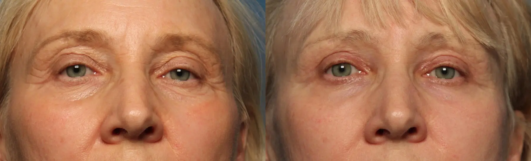 Eyelid Lift: Patient 55 - Before and After 1