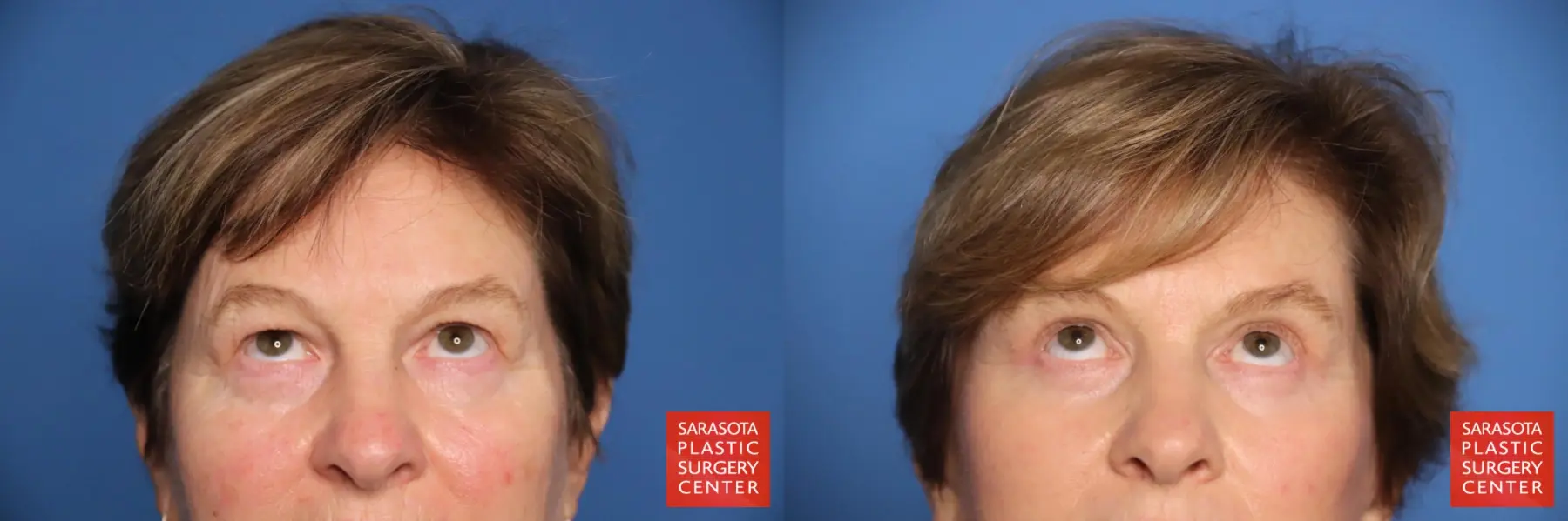 Eyelid Lift: Patient 67 - Before and After 2