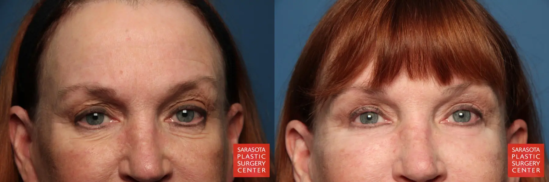 Eyelid Lift: Patient 28 - Before and After  