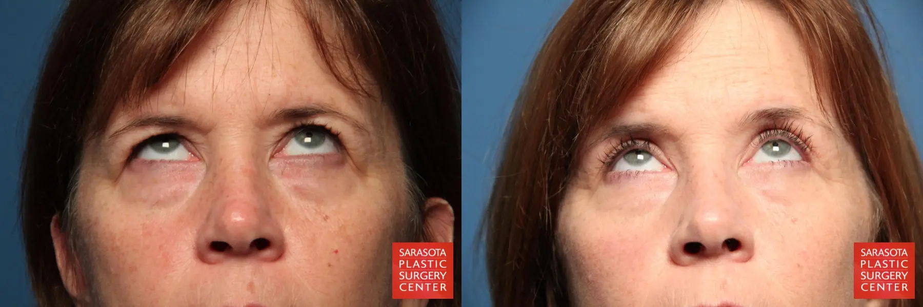 Eyelid Lift: Patient 36 - Before and After 4