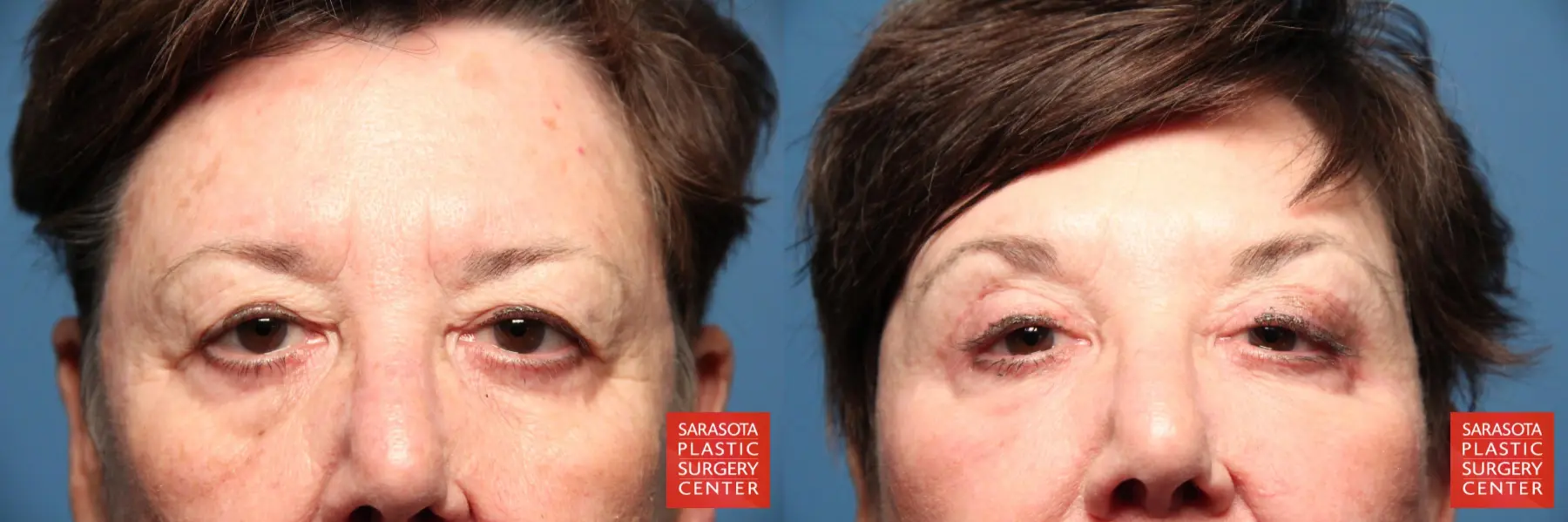 Eyelid Lift: Patient 17 - Before and After 1