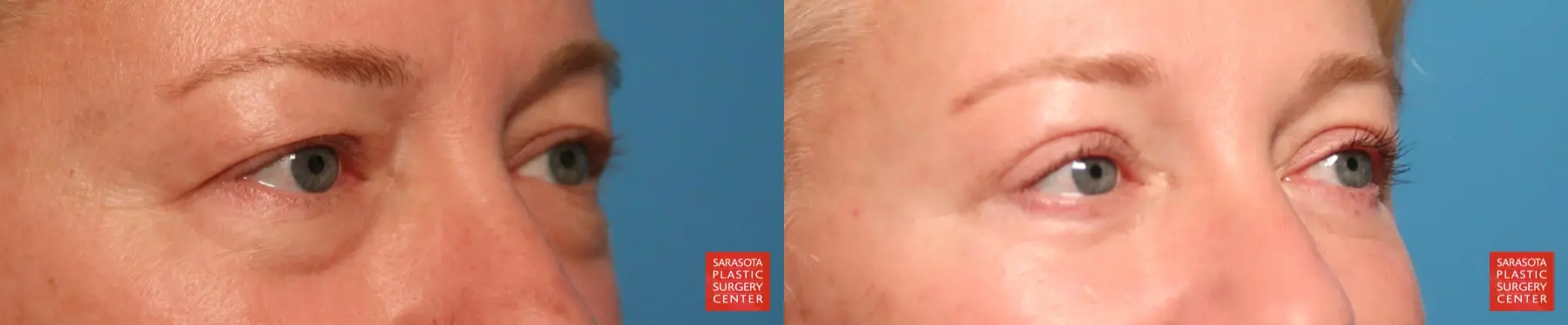 Eyelid Lift: Patient 66 - Before and After 2