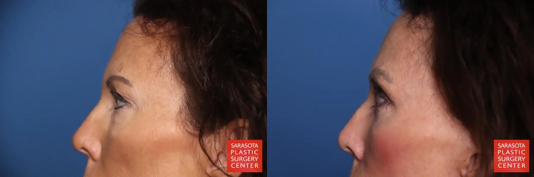 Eyelid Lift: Patient 64 - Before and After 3