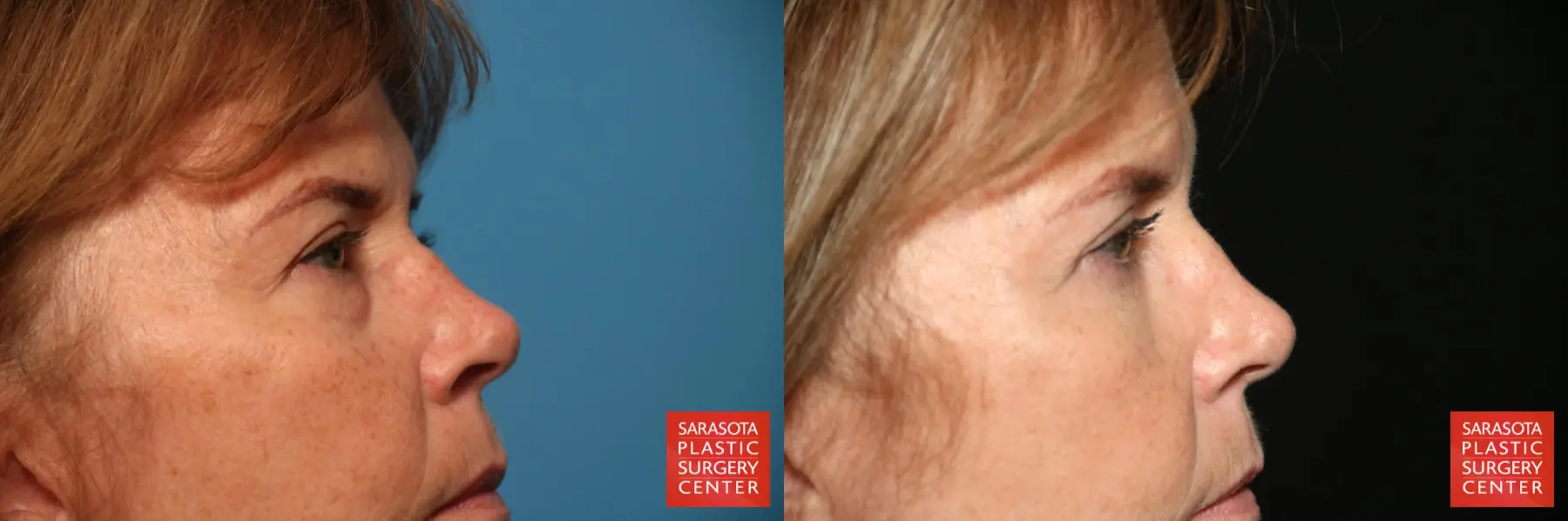 Eyelid Lift: Patient 38 - Before and After 4