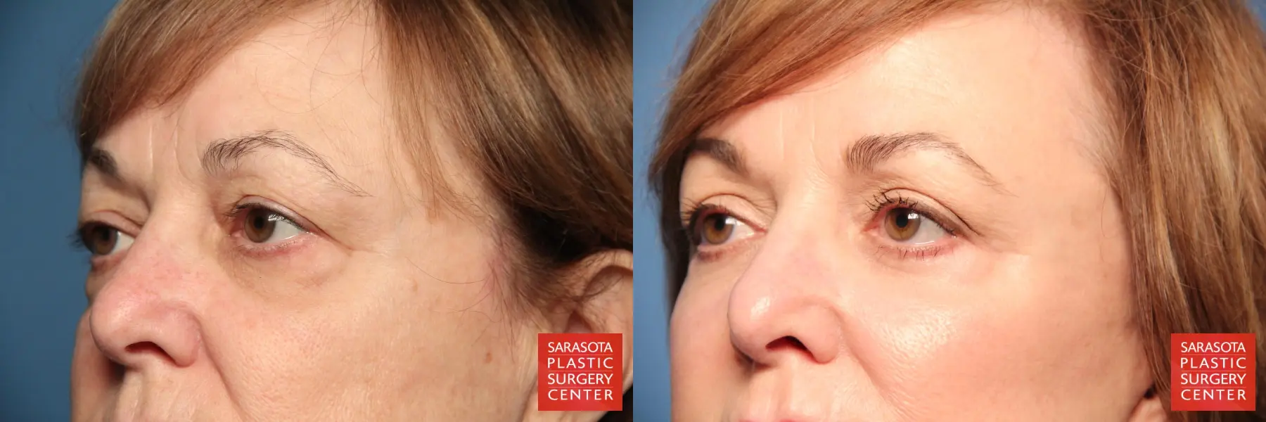 Eyelid Lift: Patient 70 - Before and After 2