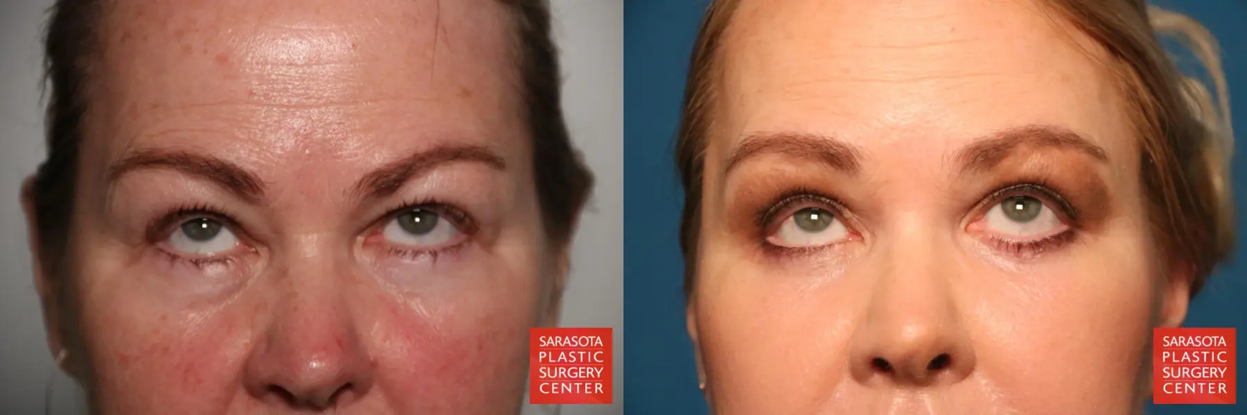 Eyelid Lift: Patient 44 - Before and After 3