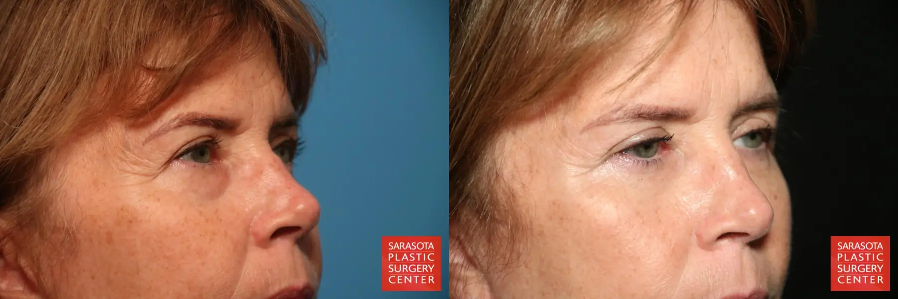 Eyelid Lift: Patient 37 - Before and After 3