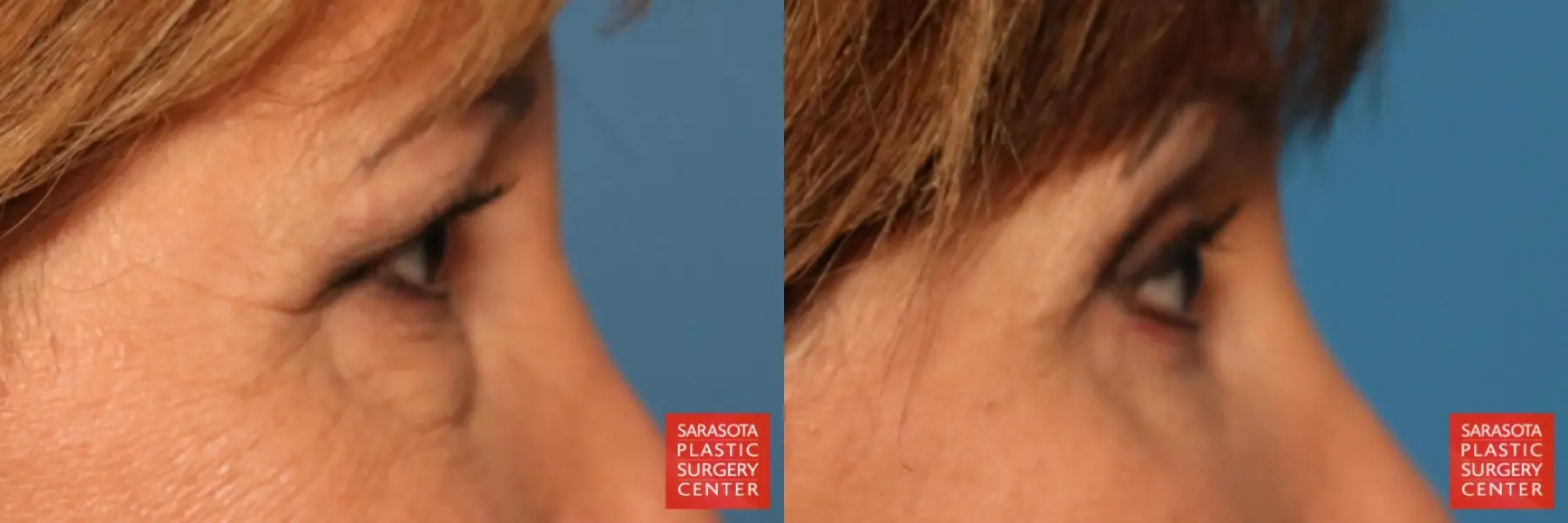 Eyelid Lift: Patient 9 - Before and After 7