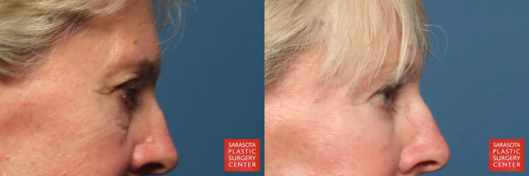 Eyelid Lift: Patient 32 - Before and After 3