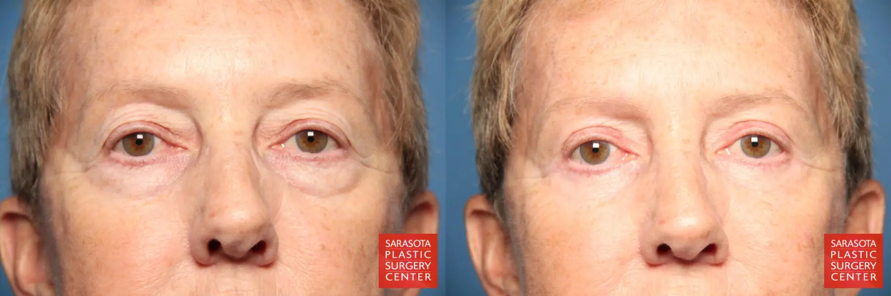 Eyelid Lift: Patient 24 - Before and After  