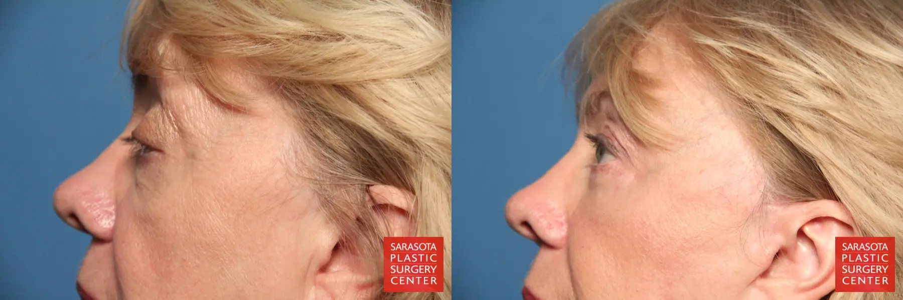 Eyelid Lift: Patient 23 - Before and After 3
