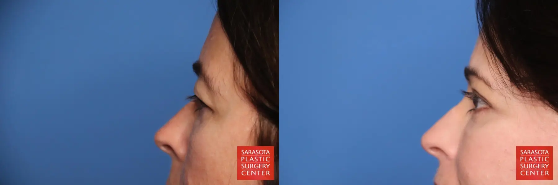 Eyelid Lift: Patient 3 - Before and After 5