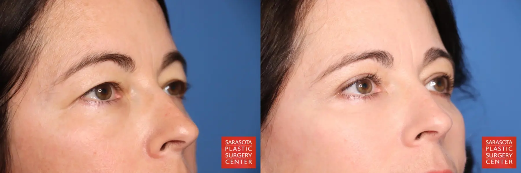 Eyelid Lift: Patient 3 - Before and After 6