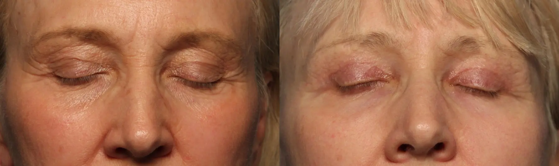 Eyelid Lift: Patient 55 - Before and After 4
