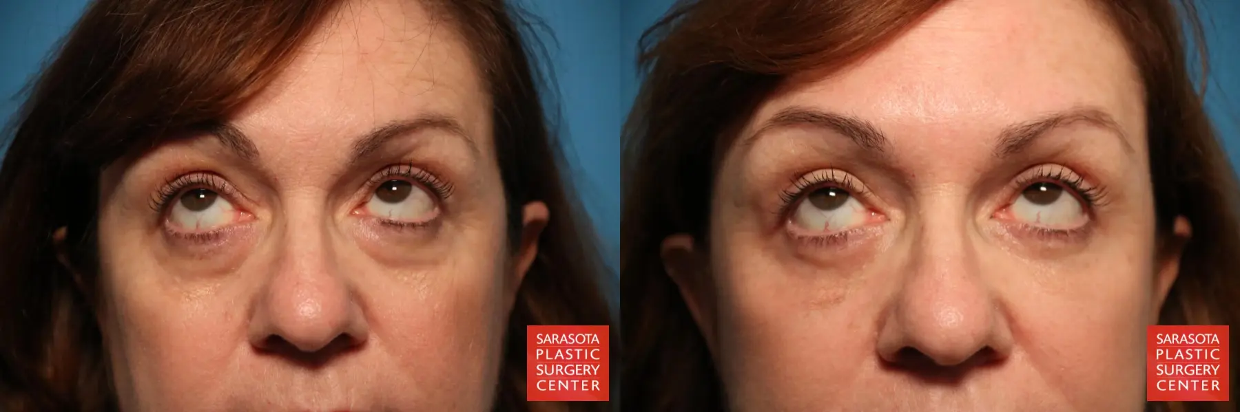 Eyelid Lift: Patient 31 - Before and After 2