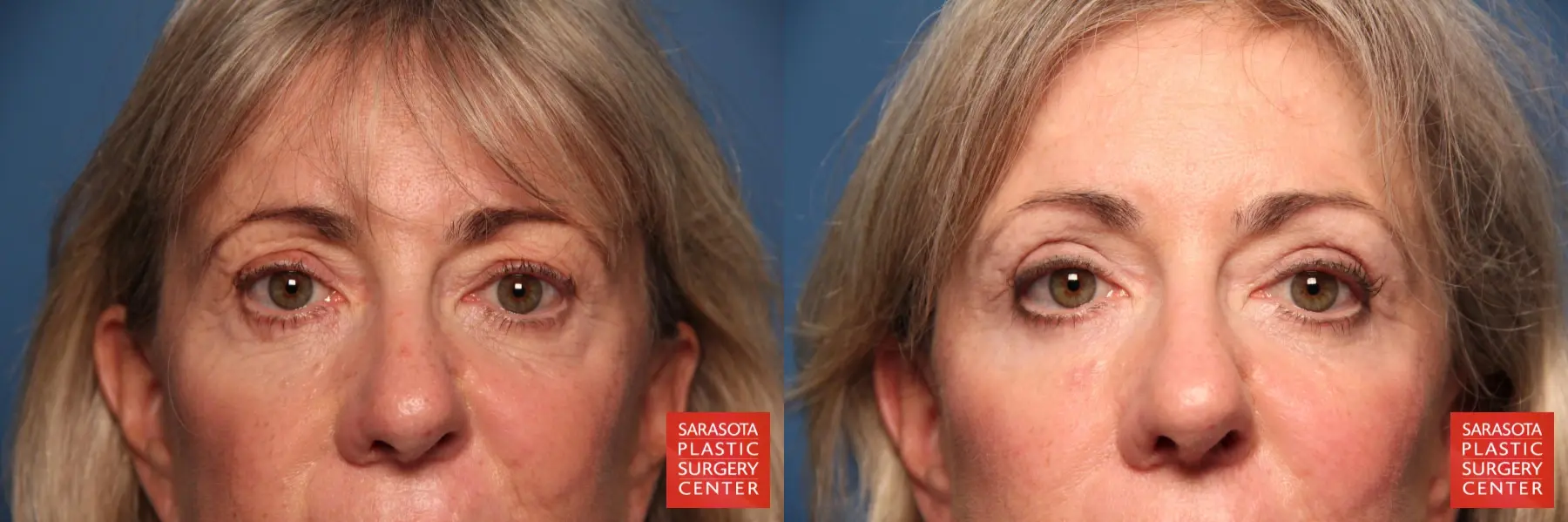 Eyelid Lift: Patient 25 - Before and After  