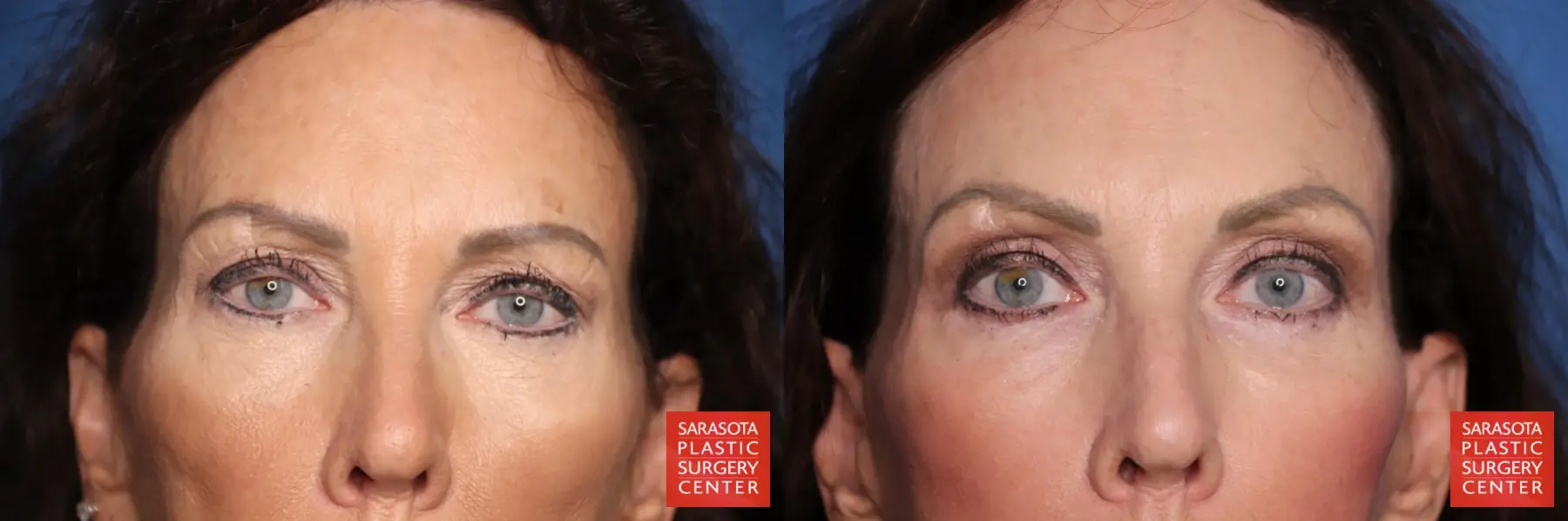 Eyelid Lift: Patient 64 - Before and After 1
