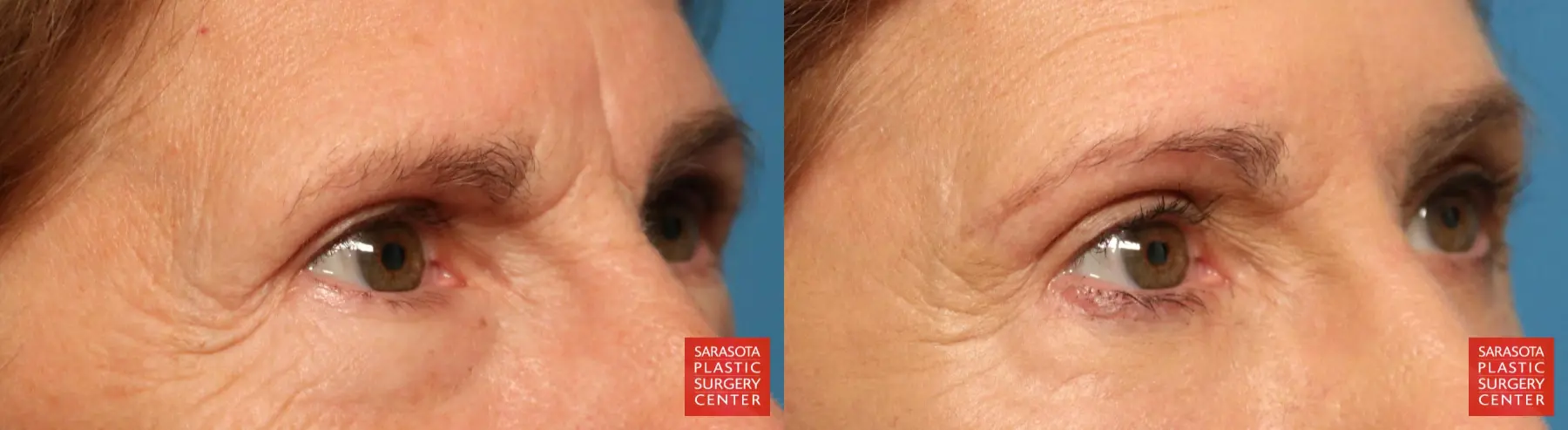 Eyelid Lift: Patient 28 - Before and After 4