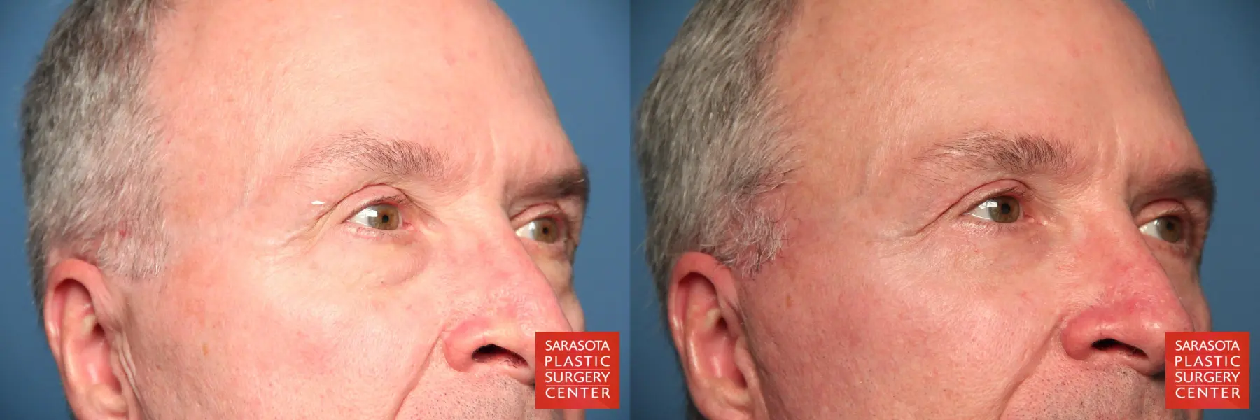 Eyelid Lift For Men Revision: Patient 1 - Before and After 5