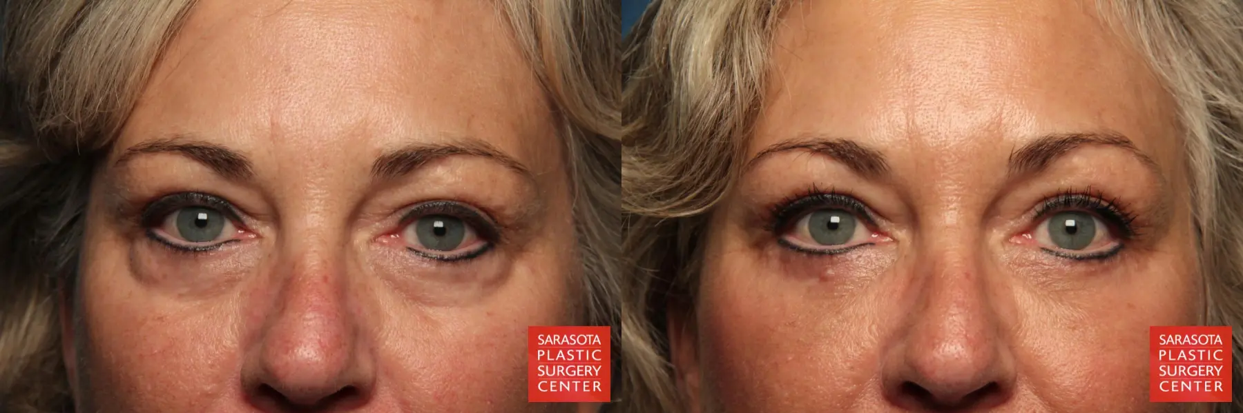 Eyelid Lift: Patient 38 - Before and After 1