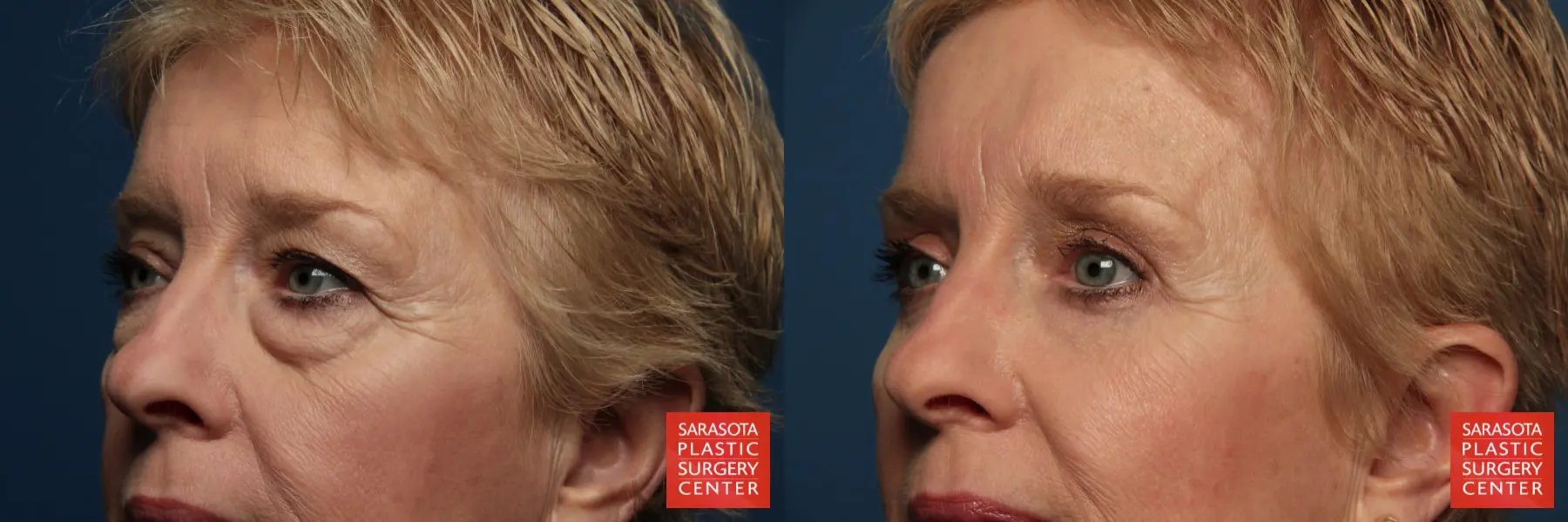 Eyelid Lift: Patient 1 - Before and After 2