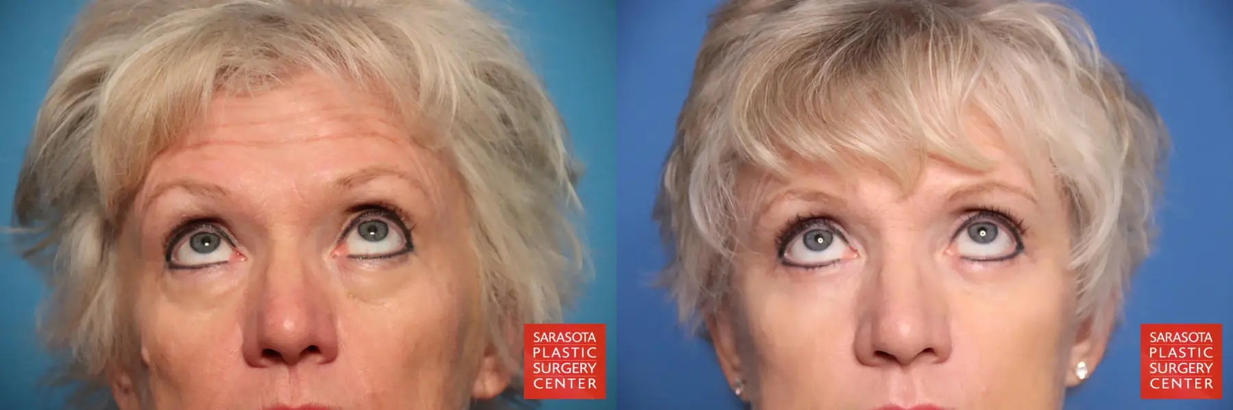 Eyelid Lift: Patient 50 - Before and After 2
