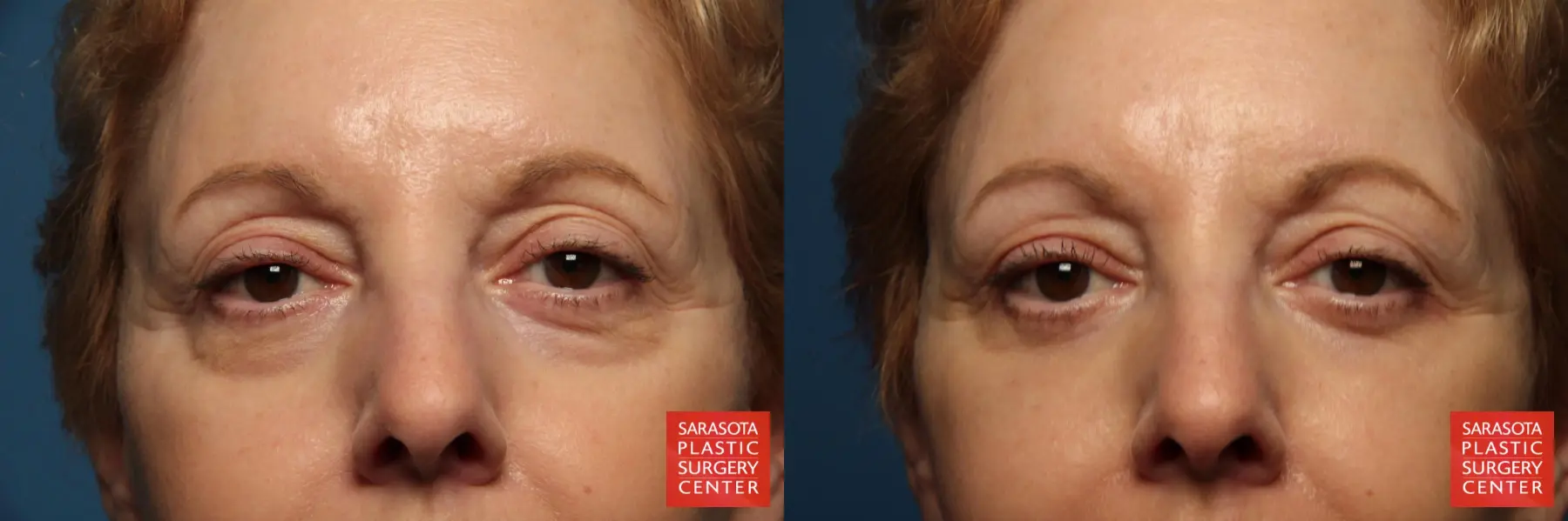 Eyelid Lift: Patient 41 - Before and After 1
