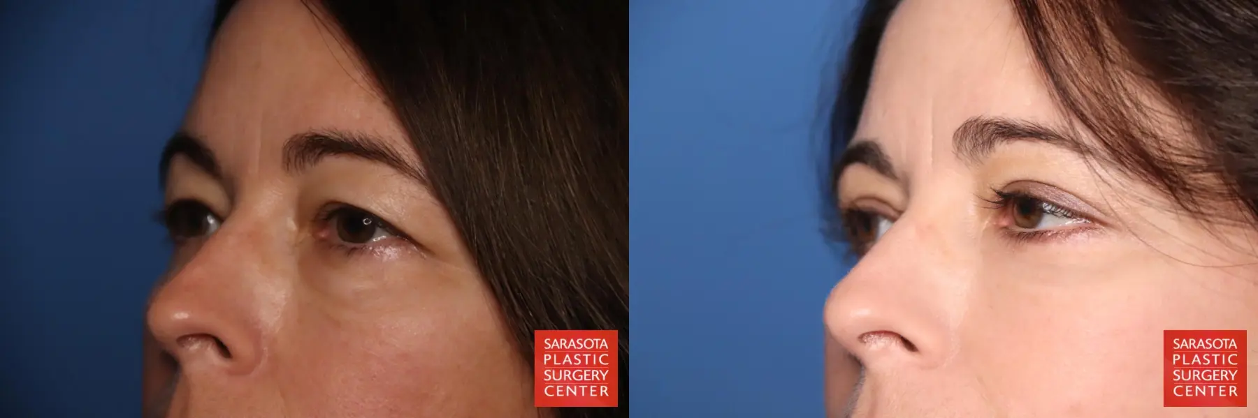 Eyelid Lift: Patient 3 - Before and After 4
