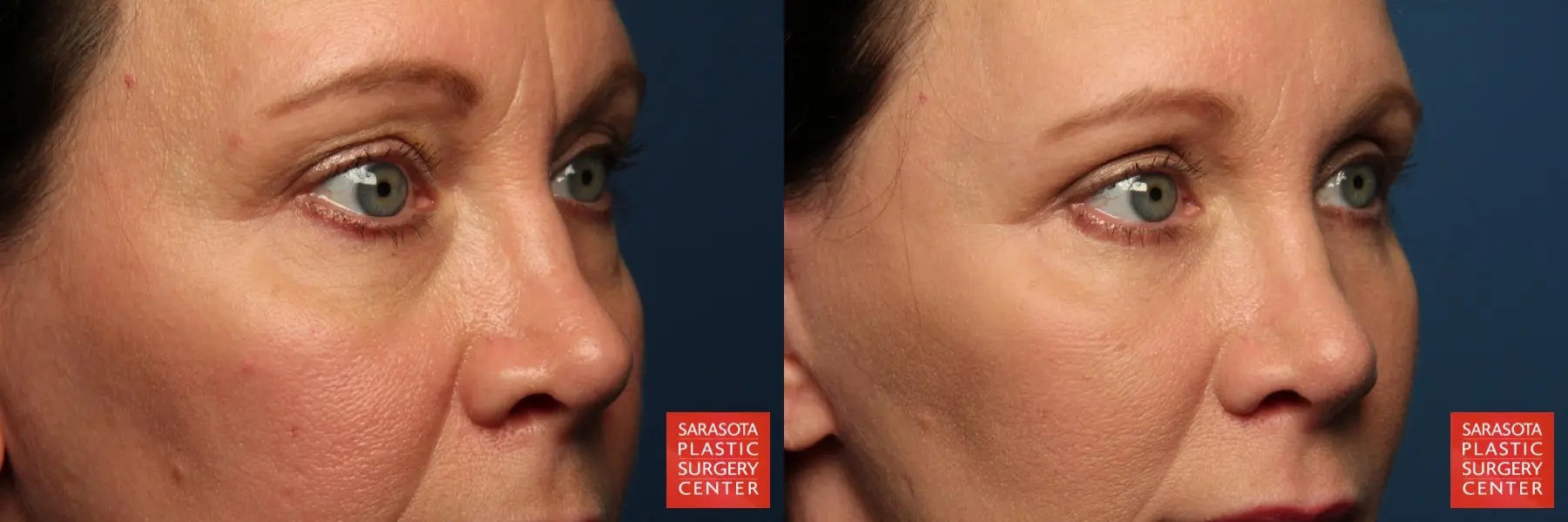 Eyelid Lift: Patient 40 - Before and After 4