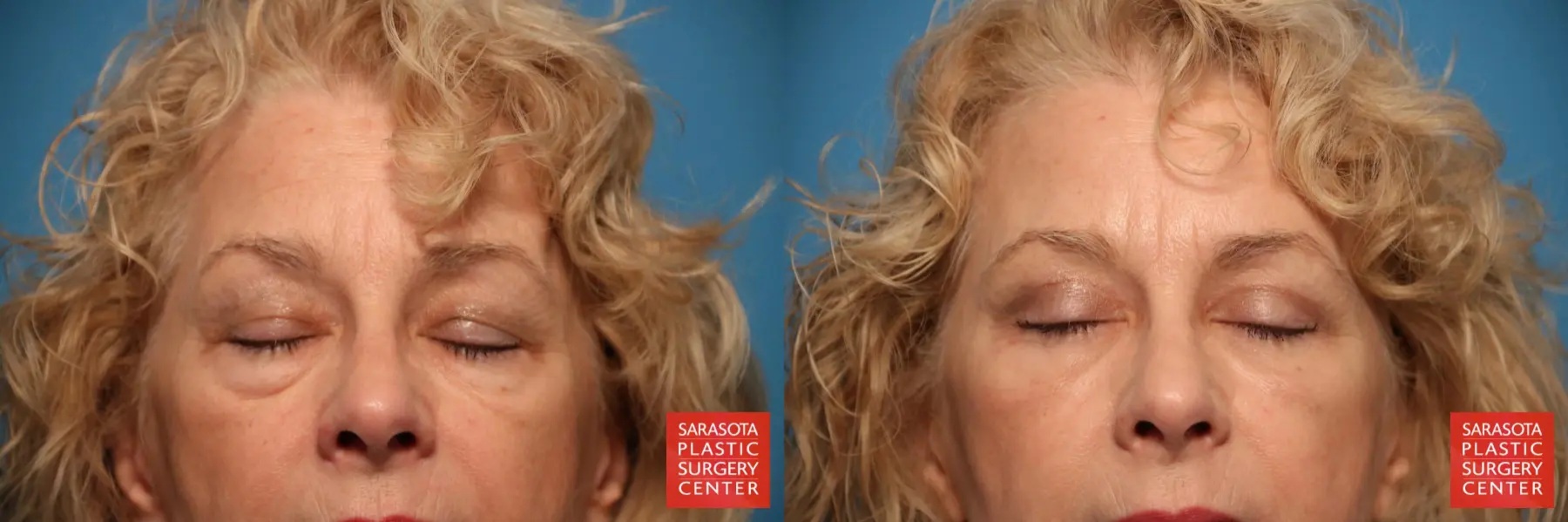 Eyelid Lift: Patient 20 - Before and After 2