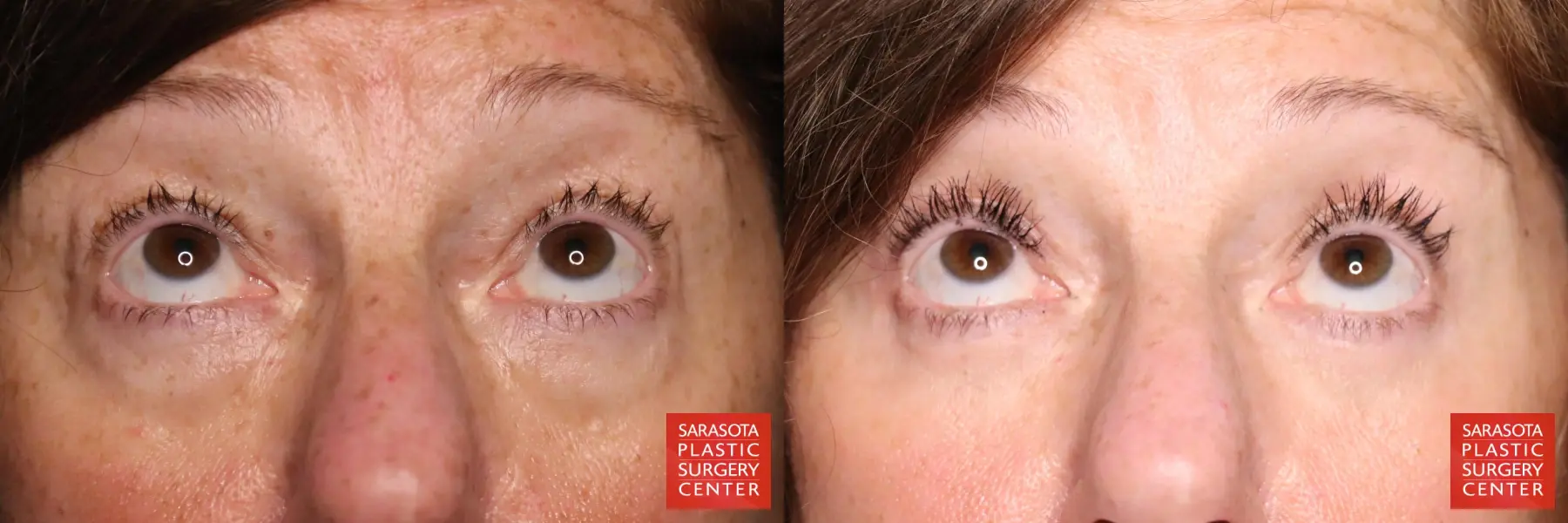 Eyelid Lift: Patient 58 - Before and After 2