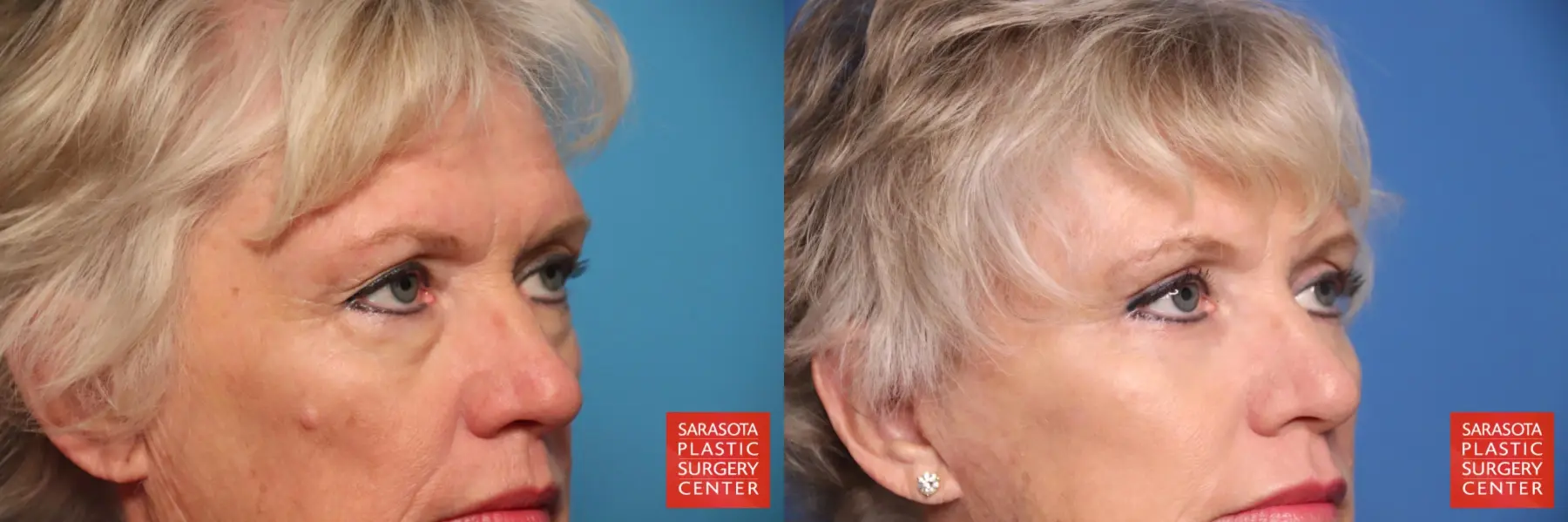 Eyelid Lift: Patient 50 - Before and After 6