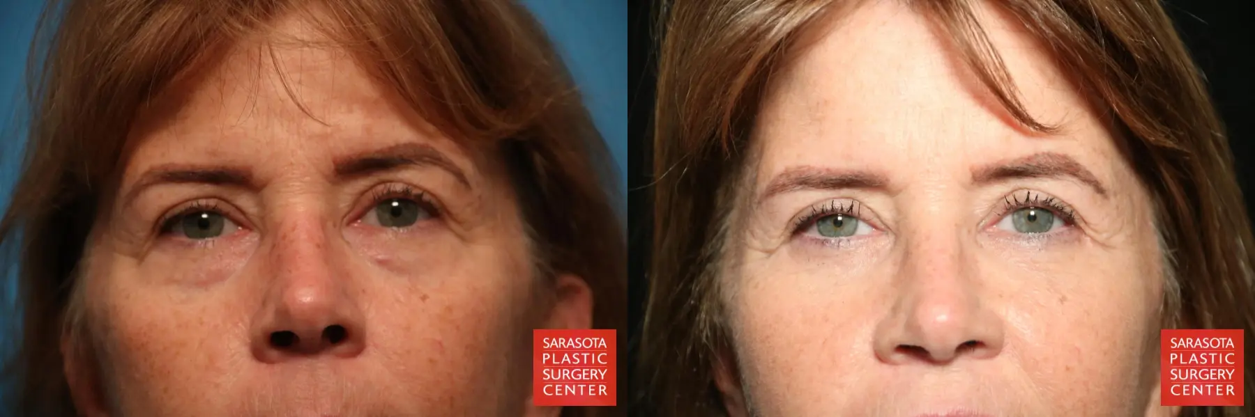Eyelid Lift: Patient 37 - Before and After 1