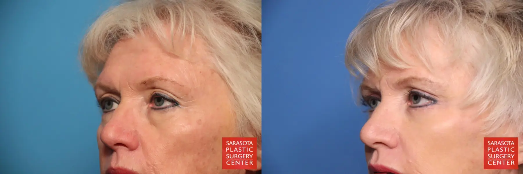 Eyelid Lift: Patient 49 - Before and After 4