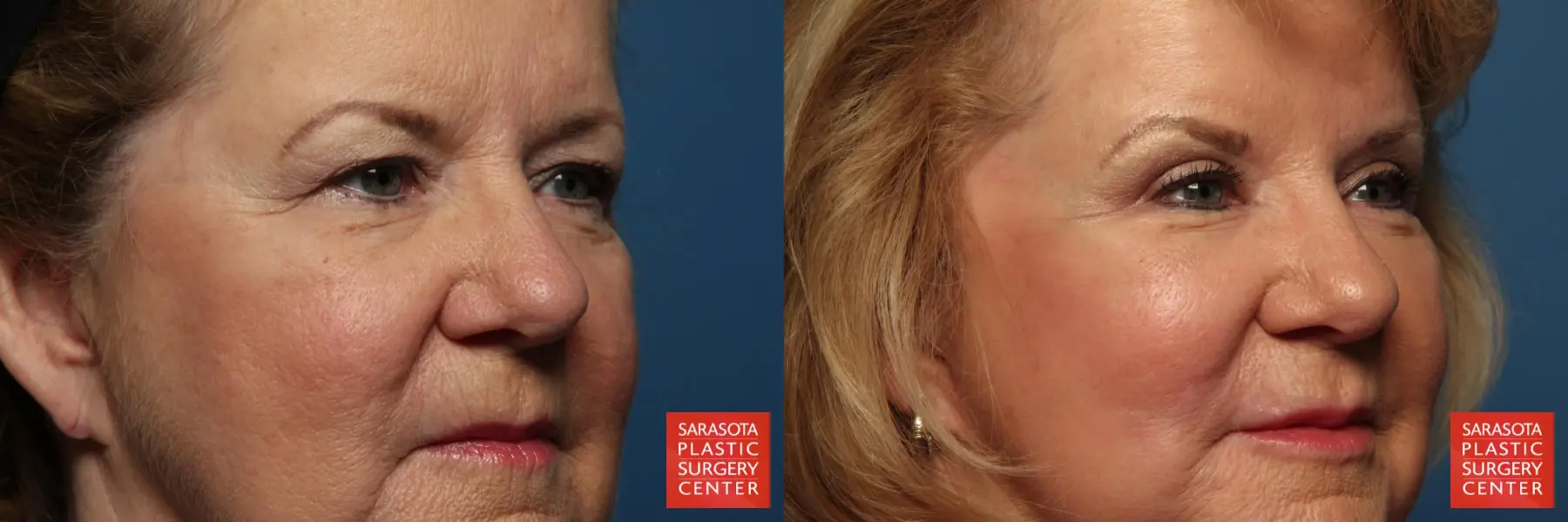 Eyelid Lift: Patient 33 - Before and After 4
