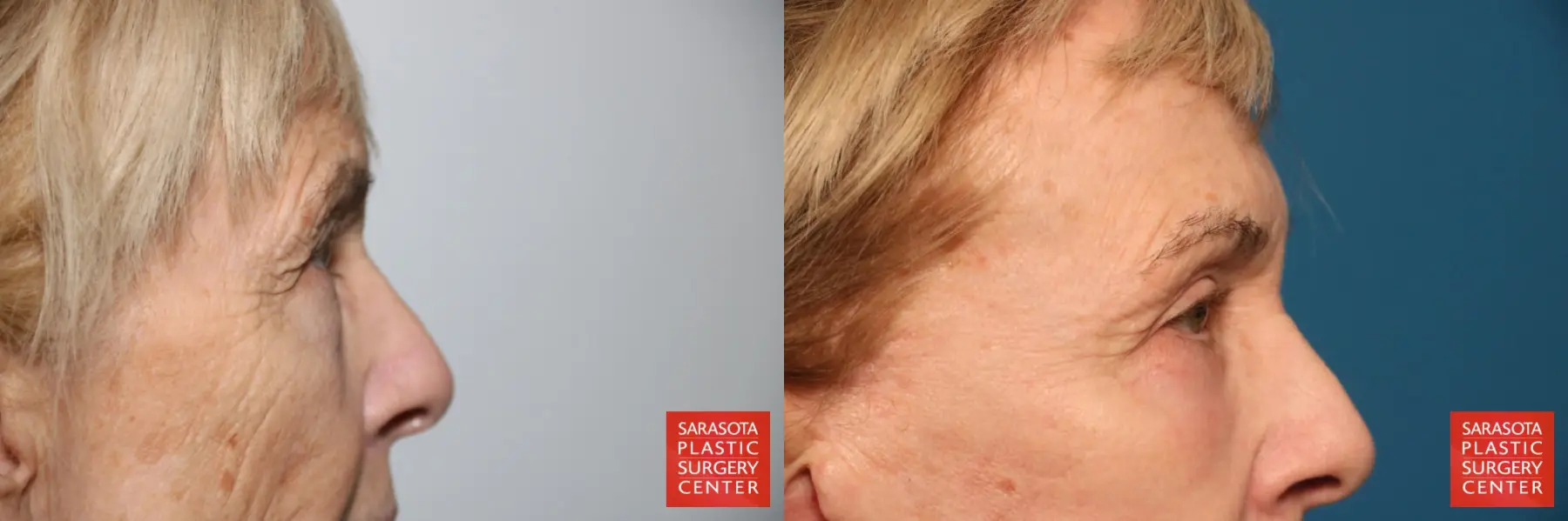 Eyelid Lift: Patient 43 - Before and After 4