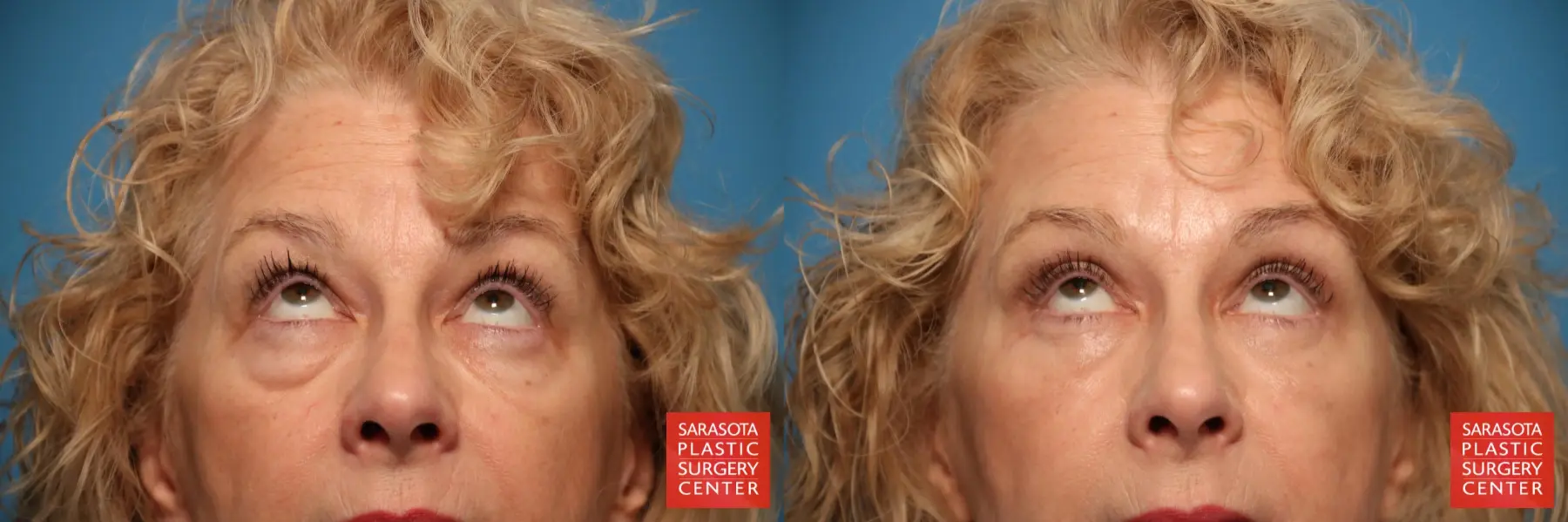 Eyelid Lift: Patient 20 - Before and After 3