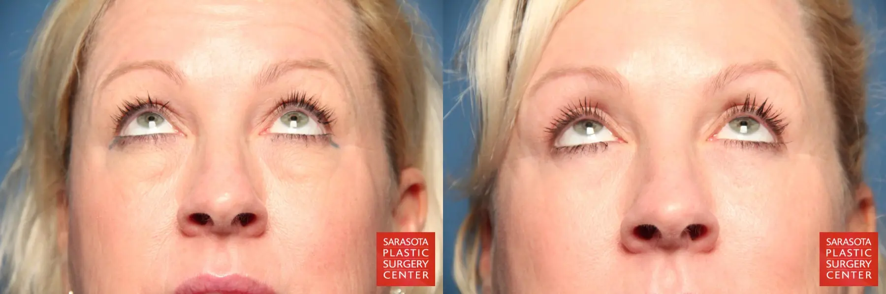 Eyelid Lift: Patient 4 - Before and After 4