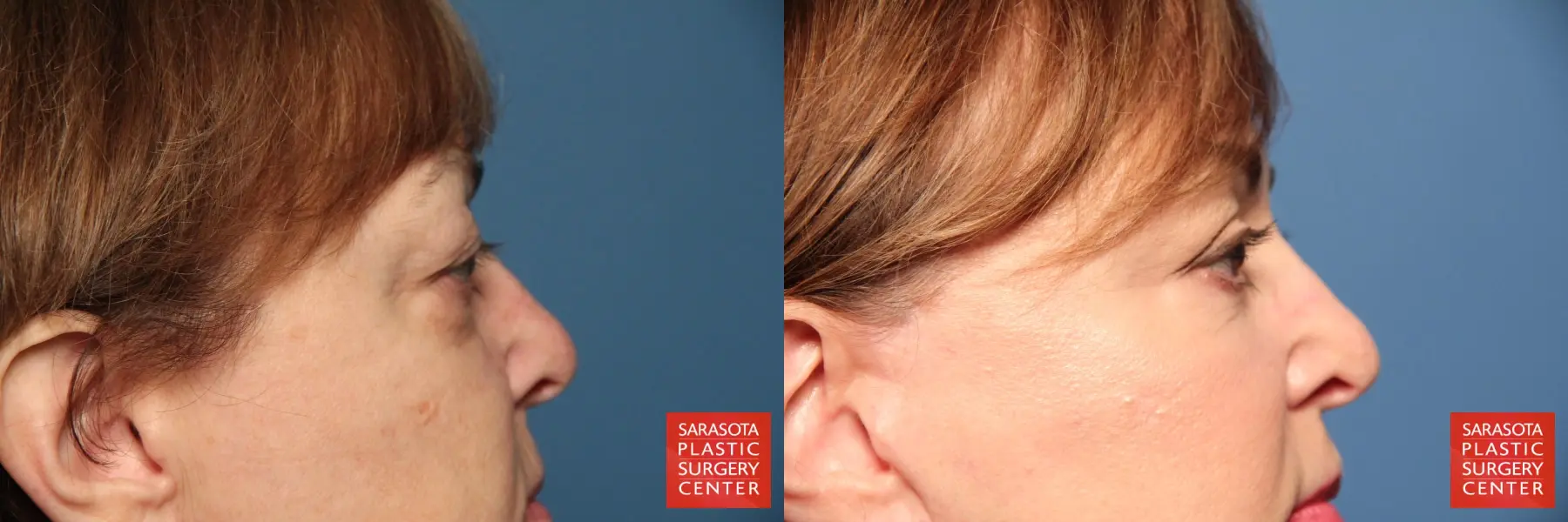 Eyelid Lift: Patient 70 - Before and After 5