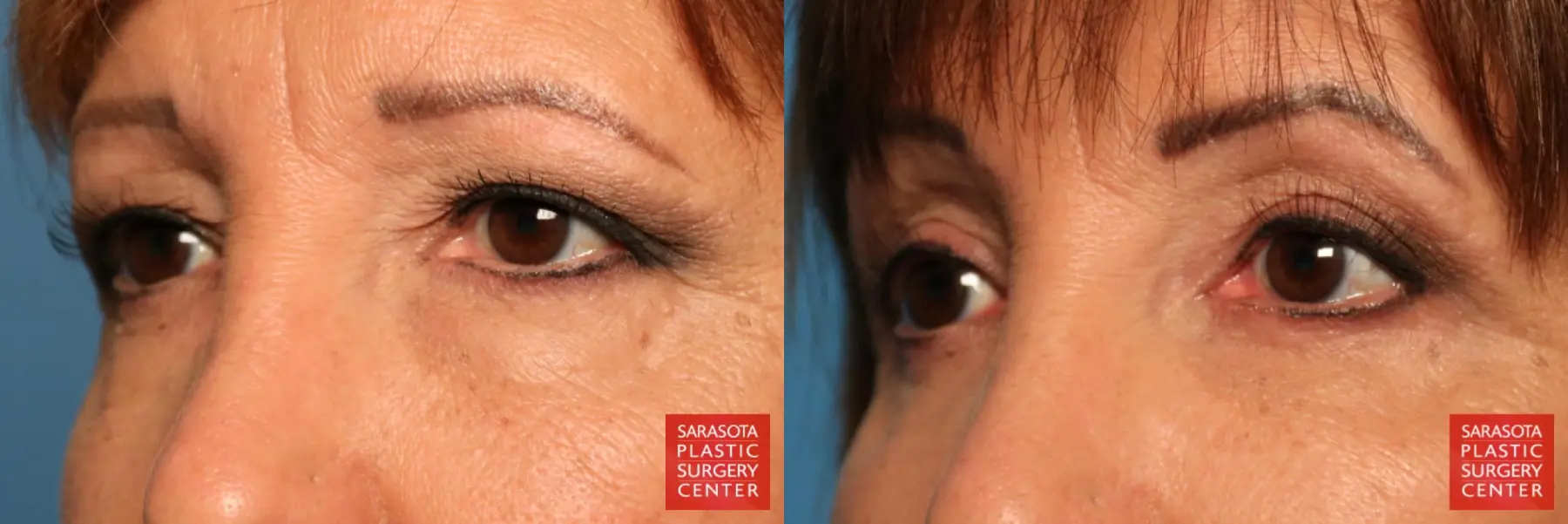 Eyelid Lift: Patient 9 - Before and After 4