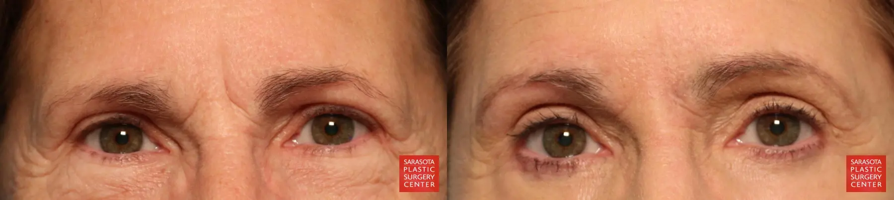 Eyelid Lift: Patient 28 - Before and After 1