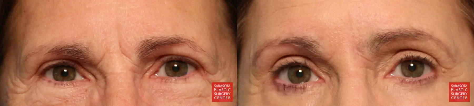 Eyelid Lift: Patient 29 - Before and After  