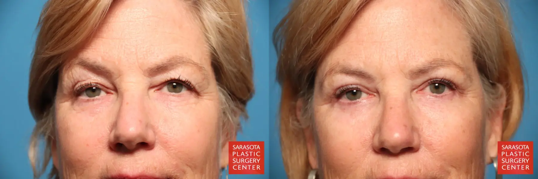 Eyelid Lift: Patient 50 - Before and After 1