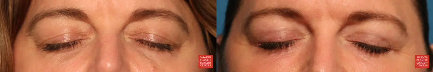 Eyelid Lift: Patient 6 - Before and After 2