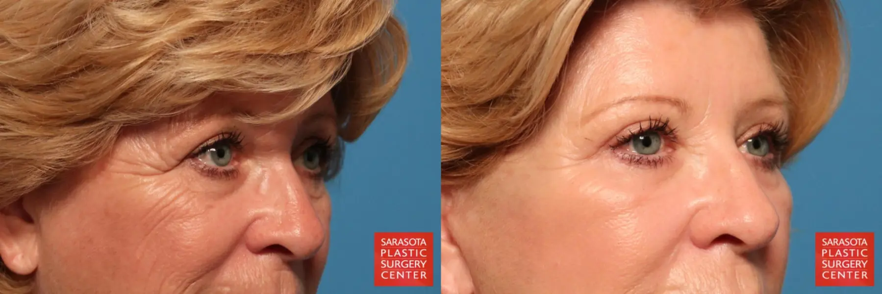 Eyelid Lift: Patient 16 - Before and After 2