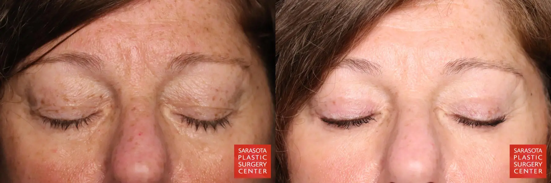 Eyelid Lift: Patient 58 - Before and After 3