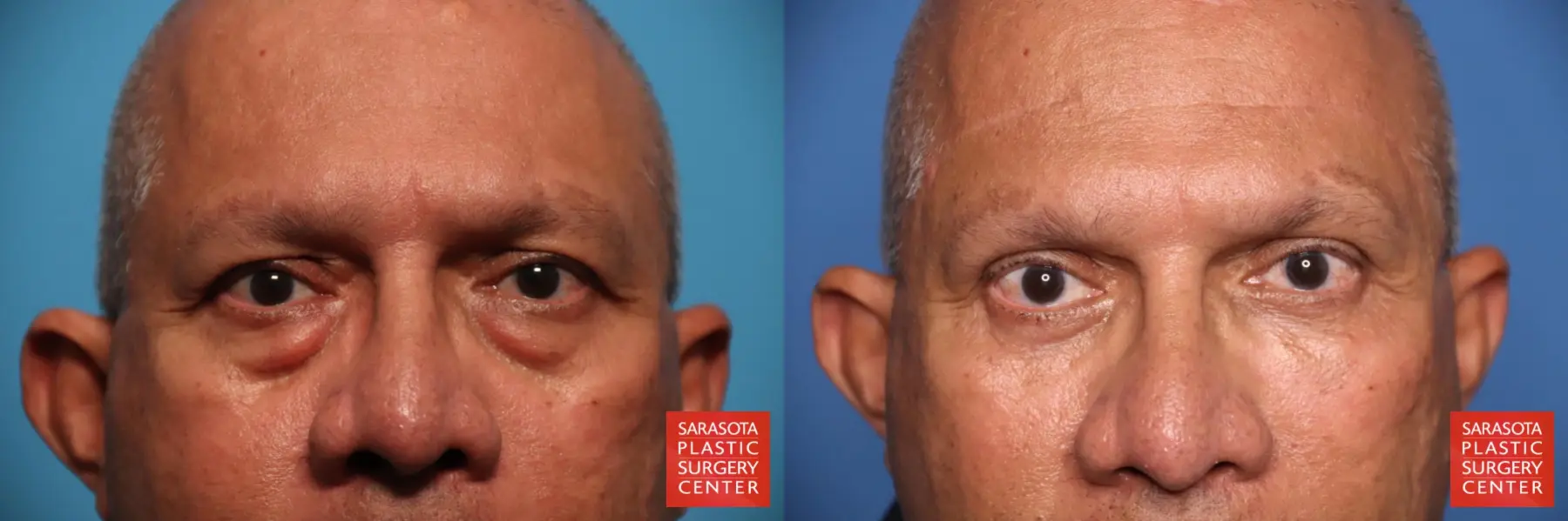 Eyelid Lift: Patient 56 - Before and After 1