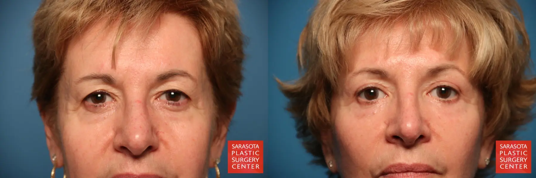 Eyelid Lift: Patient 28 - Before and After 1