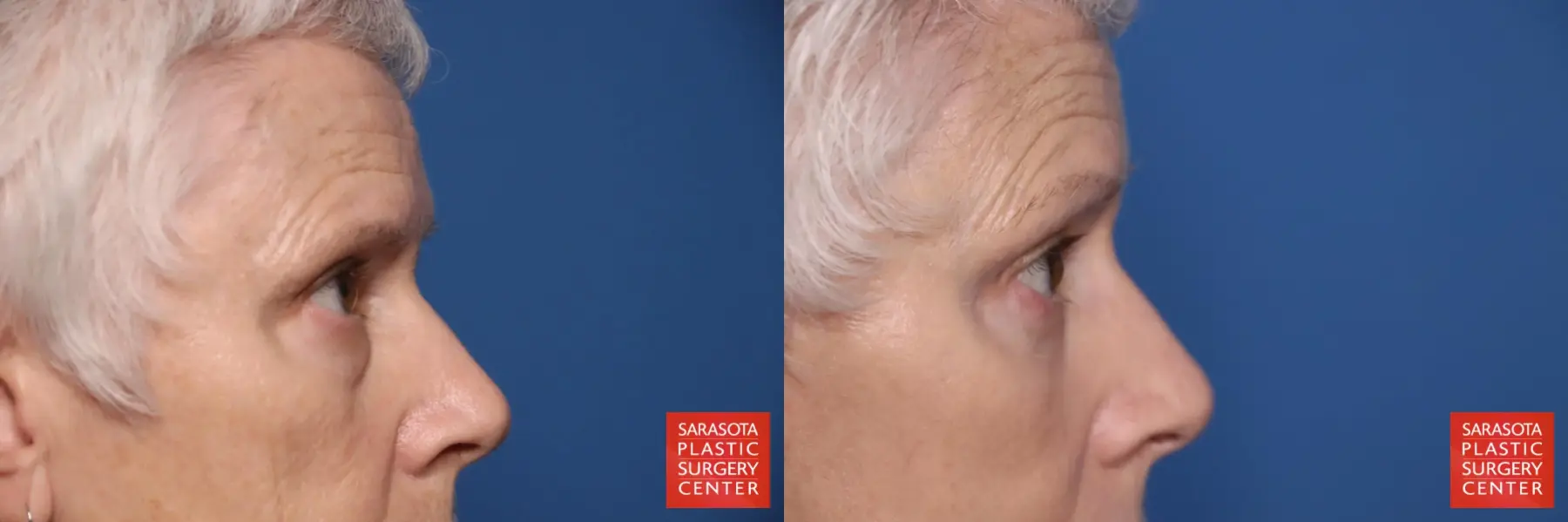 Eyelid Lift: Patient 55 - Before and After 7